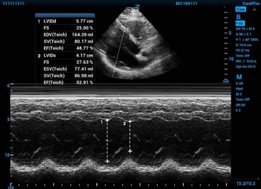 lv fractional area change|advanced critical care fractional area change.